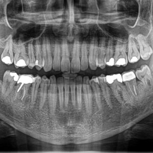 عکس رادیولوژی دهان و دندان